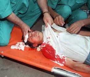 Photo: Palestinian boy shot in the head with live ammunition during the clashes