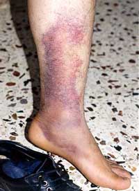 Photo: Close-up of the result of Suffiyan's torture